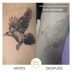 elimnar-tatuaje-laser-1