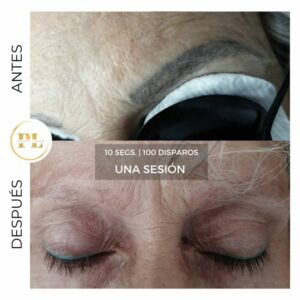 elimnar-tatuaje-laser-2