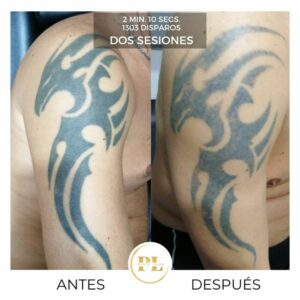 elimnar-tatuaje-laser-3
