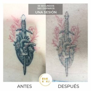 elimnar-tatuaje-laser-5