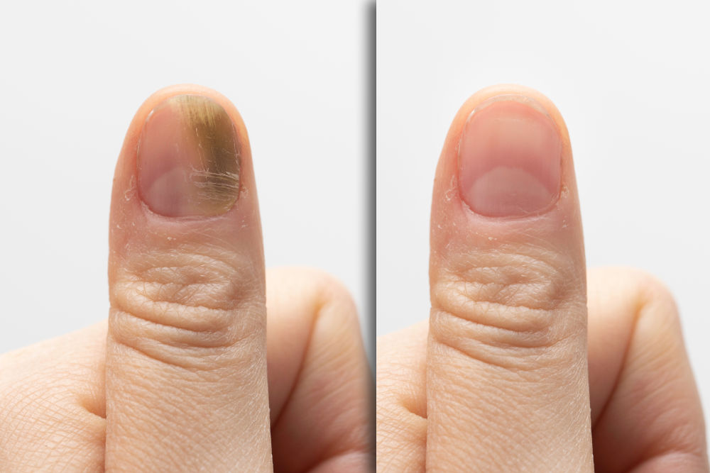 Onicomicosis