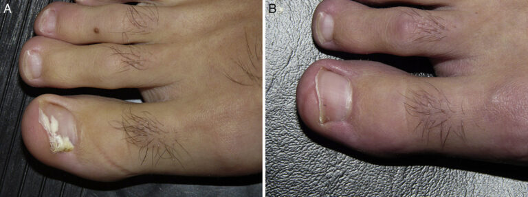 Onicomicosis